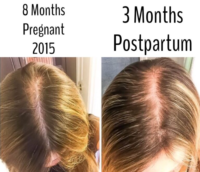 Haarausfall nach der Schwangerschaft